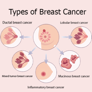 types of breast cancer